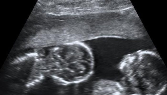 Monoamniotic_twins_at_15_weeks.jpg Monoamniotic_twins_at_15_weeks.jpg