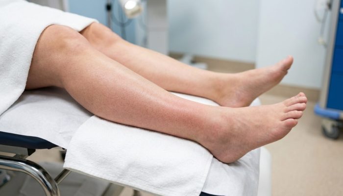 Womans_leg_with_edema_202606291955-e1782773849672.jpeg