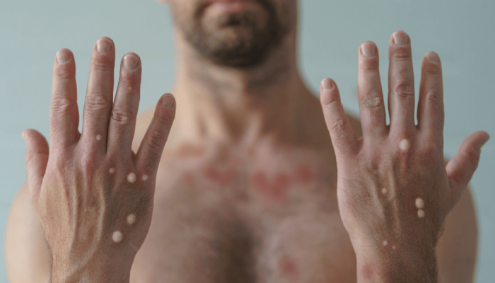 a006d1fb8e68_1000x600-monkeypox-homem-maos.png