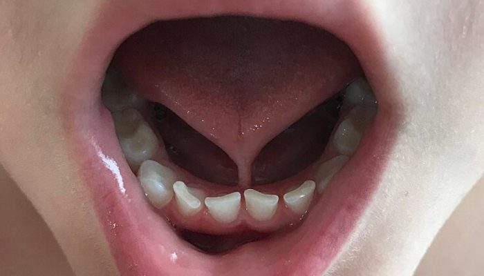 anquiloglossia-freio-lingua-frenectomia.jpg anquiloglossia-freio-lingua-frenectomia.jpg