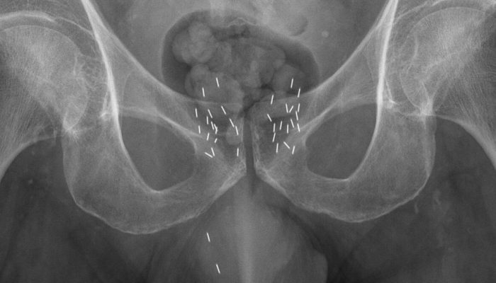 braquiterapia-radioterapia-interna.jpg braquiterapia-radioterapia-interna.jpg