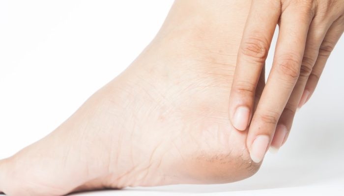 calcanhar-rachado.jpg calcanhar-rachado.jpg