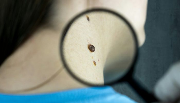 carcinoma-cancer-de-pele.jpg carcinoma-cancer-de-pele.jpg