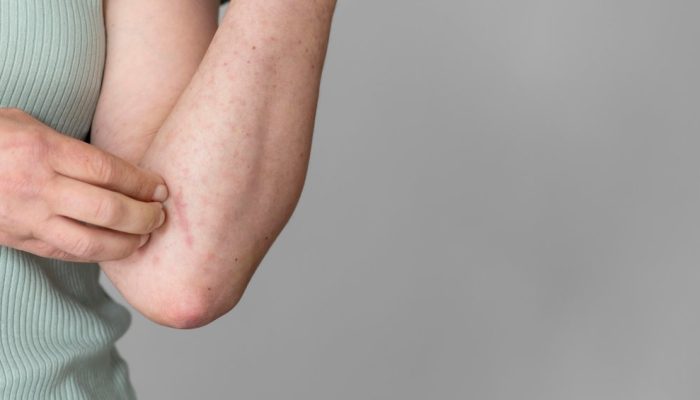 coceira-no-corpo-alergia-dermatite.jpg
