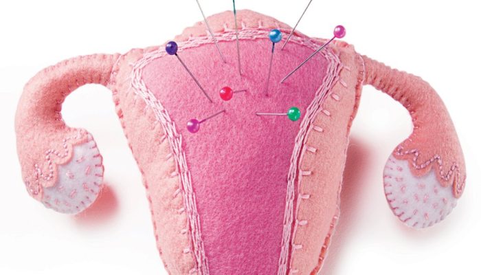 endometriose.jpg endometriose.jpg