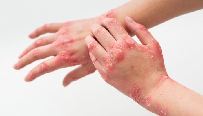 hands-patient-suffering-from-psoriasis.jpg