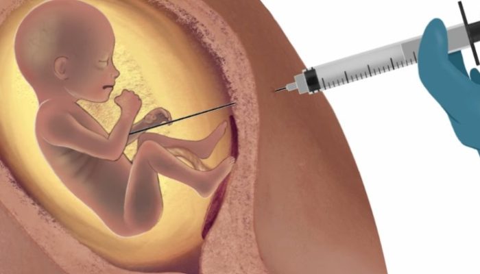 imagem-assistolia-fetal-aborto.jpg