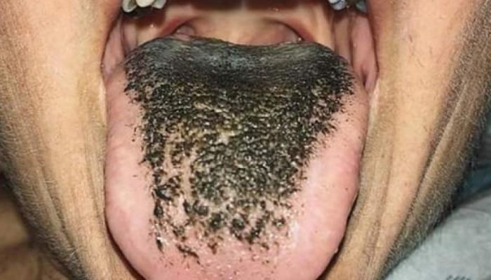 lingua-preta-pilosa.jpg