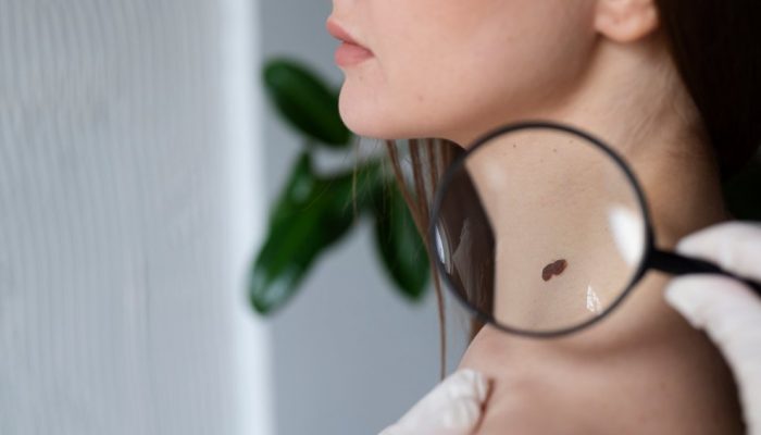 medica-diagnosticando-um-melanoma-no-corpo-de-uma-paciente-sexo-feminino.jpg