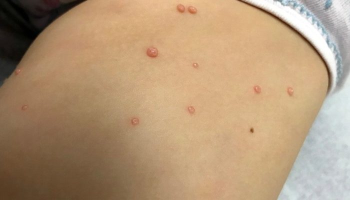 molusco-contagioso-doenca-pele.jpg molusco-contagioso-doenca-pele.jpg