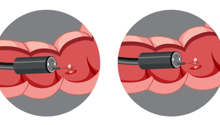 polipos-intestinais.jpg polipos-intestinais.jpg