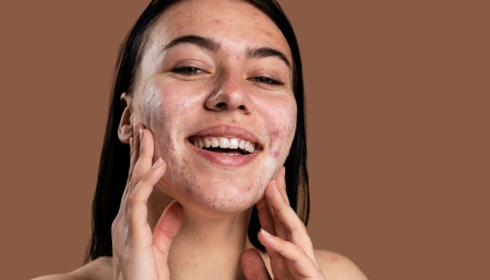 purging-acne-skincare-reacao.jpg purging-acne-skincare-reacao.jpg