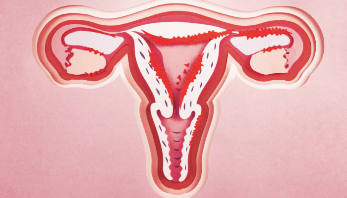 saude-medicina-endometriose-utero.png saude-medicina-endometriose-utero.png