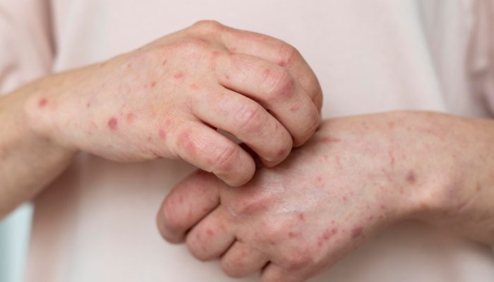 skin-allergy-person-s-arm.jpg